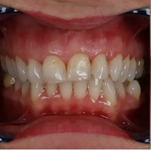 Smile Makeover - Before