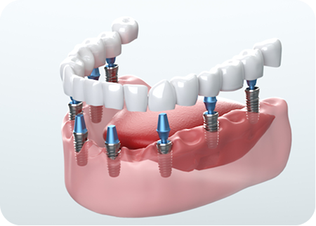 Dental Implants