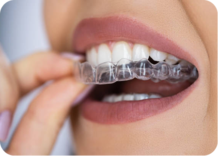 Invisalign / Clear Aligners