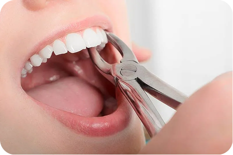 Tooth Extraction